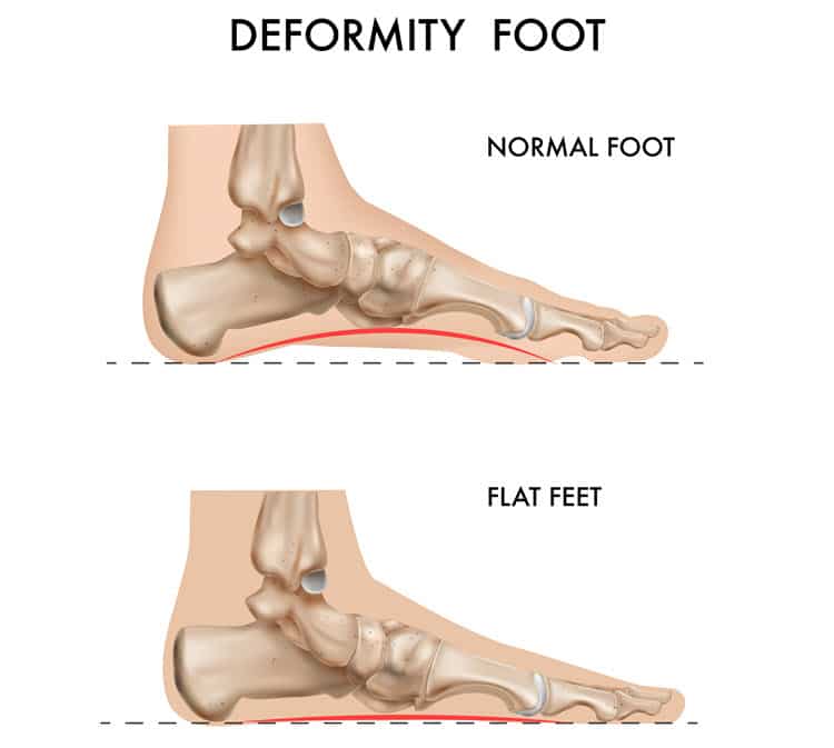 Deformity foot