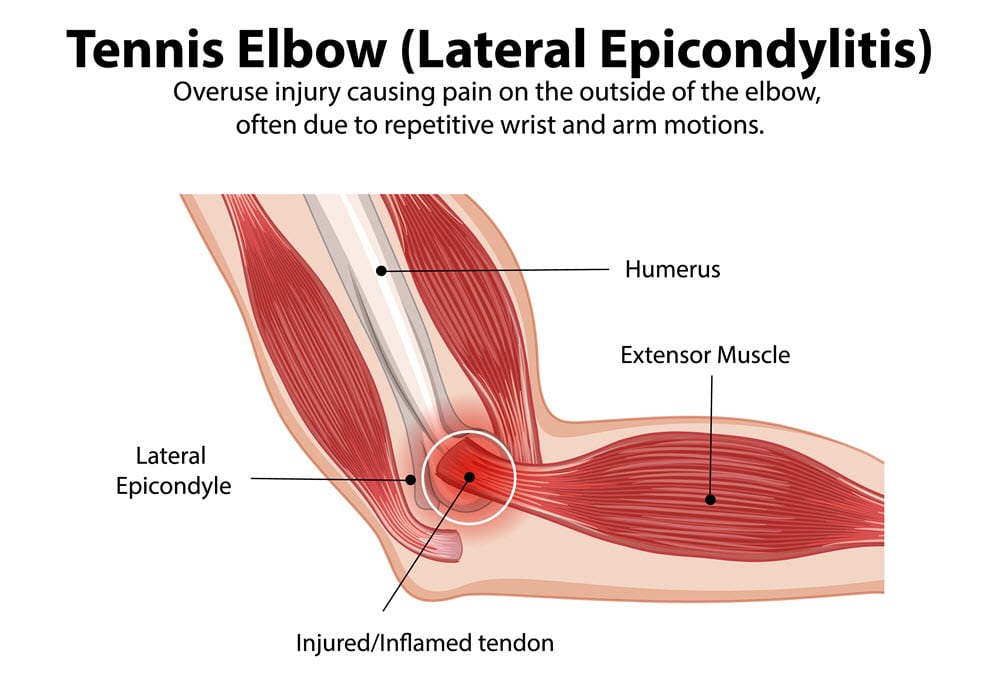 Tennis elbow pain