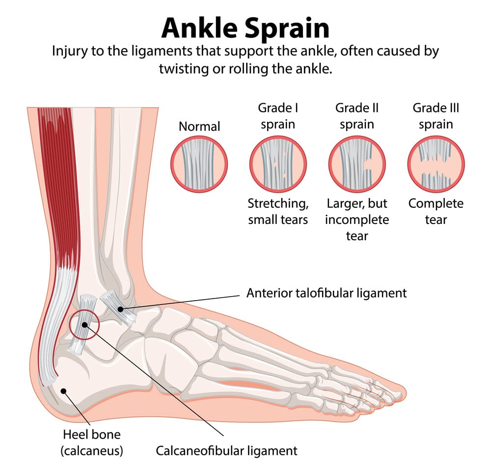 ankle sprain