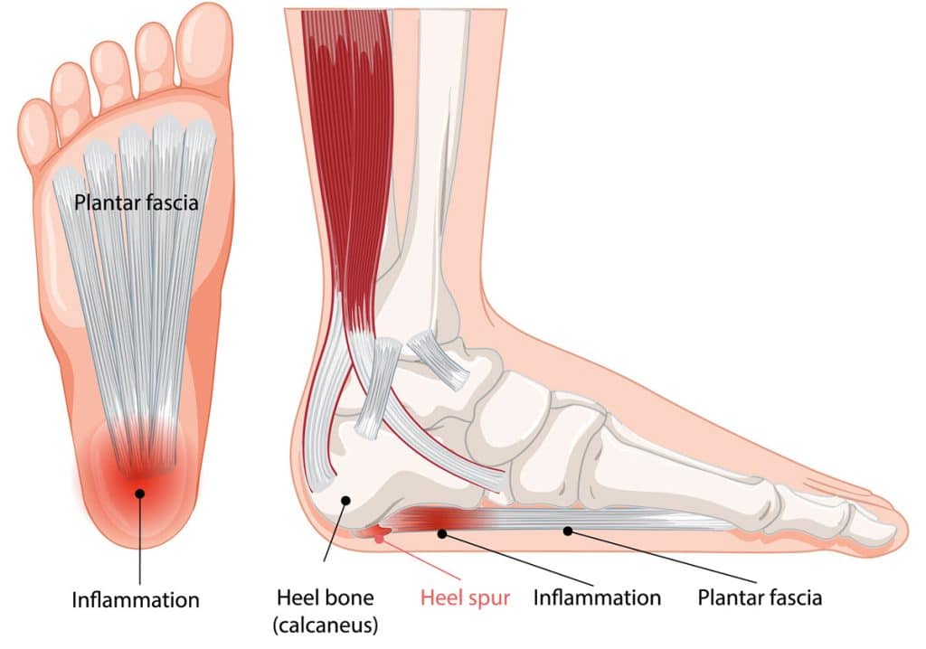 heel spurs