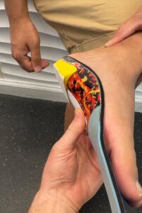 Custom Orthotic Fitting